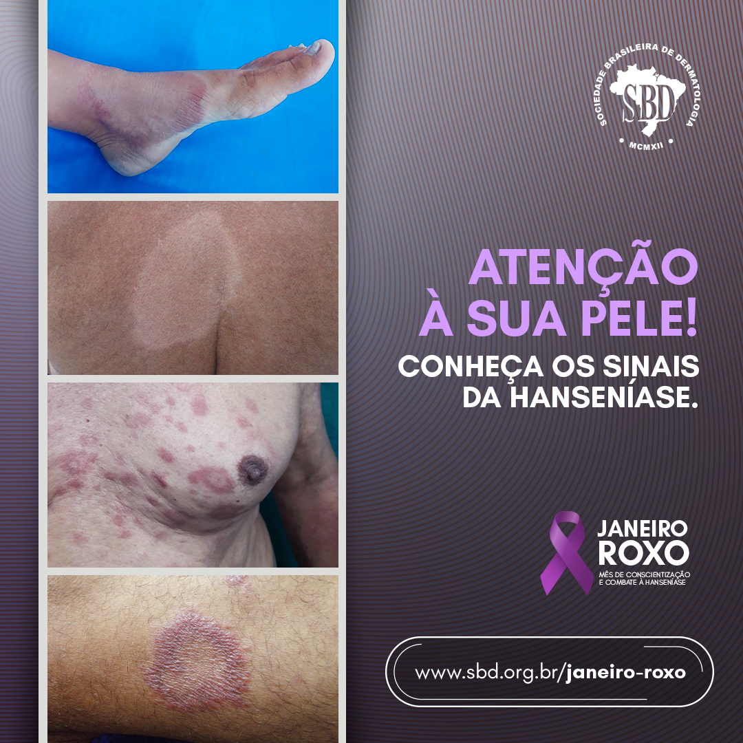 01_card-sbd-hanseníase-atenção-a-sua-pele.png